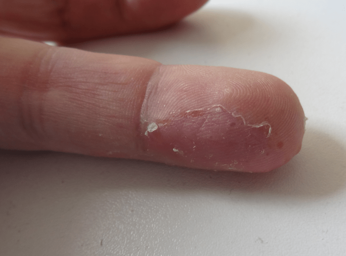 Dermatose_Dyshidrose_electrosensibilité