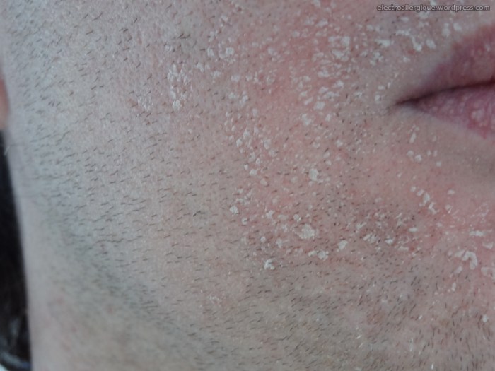 peau morte apparaissant après les rougeurs (exposition CPL)