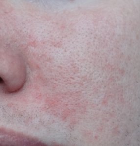 Allergie de peau suite à l'exposition de mon portable