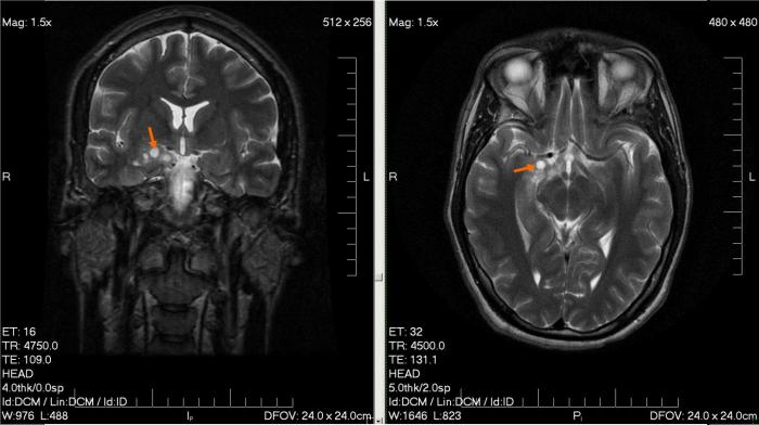MRI_glioma_28_yr_old_male
