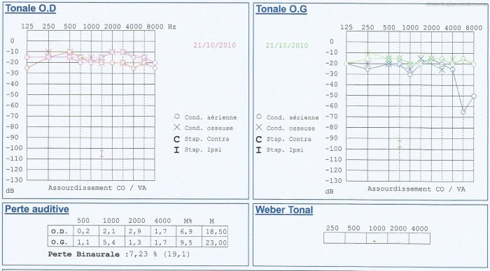 audiométrie_06102014